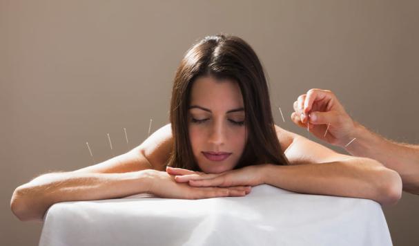 mulher com agulhas de acupultura nas costas